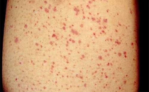 ʲô�ǹ�������� ���������֢״